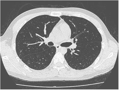 Case report: Difficult diagnosis of Mycobacterium tuberculosis infection in patients after allogeneic hematopoietic stem cell transplantation: two case reports and a literature review